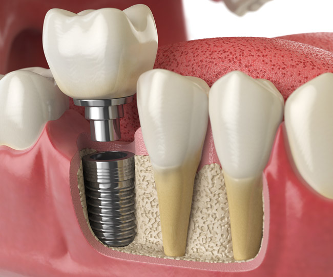 vancouverharbourdental_services_dental_implants https://vancouverharbourdental.incloud365.ca/wp-content/uploads/2023/07/vancouverharbourdental_services_dental_implants.jpg