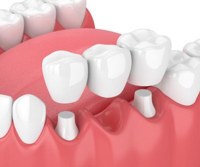 vancouverharbourdental_services_dental_bridge https://vancouverharbourdental.incloud365.ca/wp-content/uploads/2023/09/vancouverharbourdental_services_dental_bridge-640x534.jpg