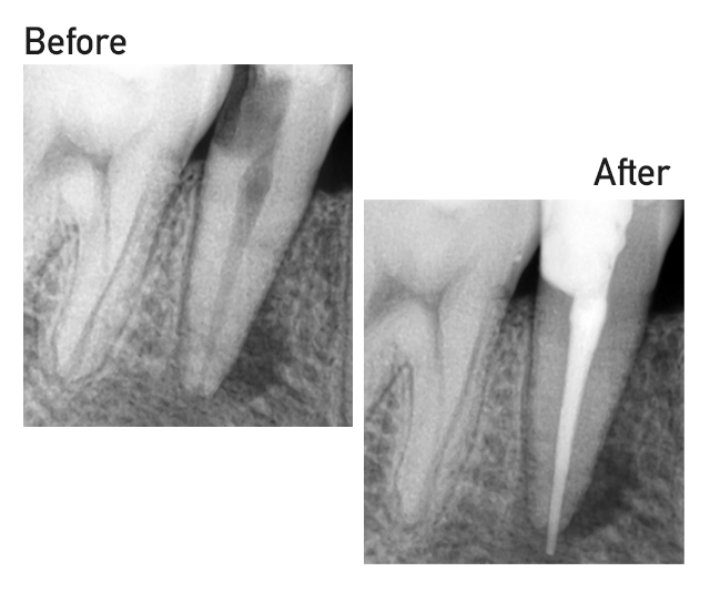 vancouverharbourdental_services_rootcanal https://vancouverharbourdental.incloud365.ca/wp-content/uploads/2023/09/vancouverharbourdental_services_rootcanal.jpg