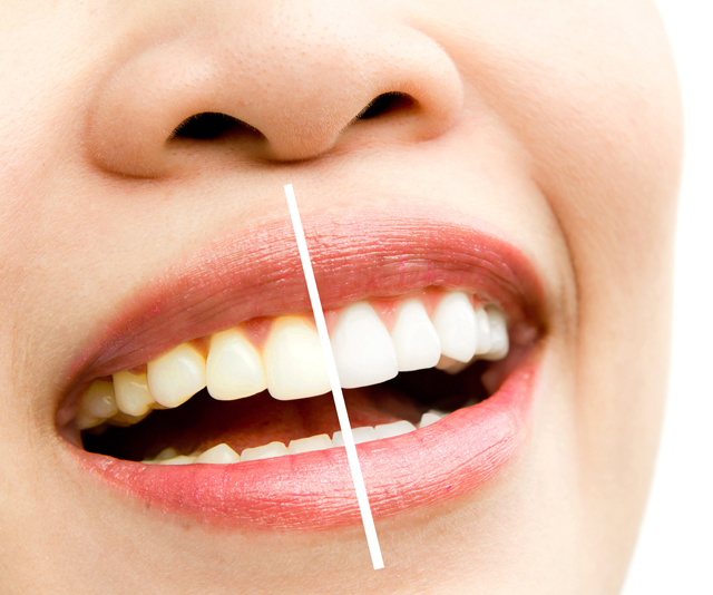 vancouverharbourdental_services_teethwhitening https://vancouverharbourdental.incloud365.ca/wp-content/uploads/2023/09/vancouverharbourdental_services_teethwhitening.jpg