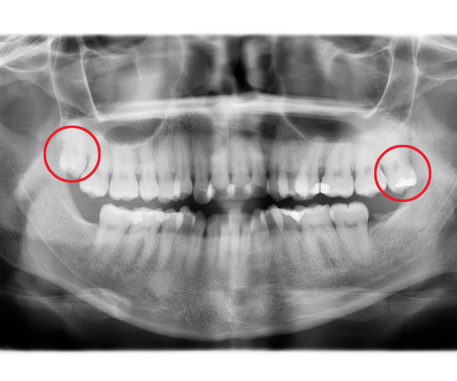 vancouverharbourdental_services_wisdomtooth https://vancouverharbourdental.incloud365.ca/wp-content/uploads/2023/09/vancouverharbourdental_services_wisdomtooth.jpg